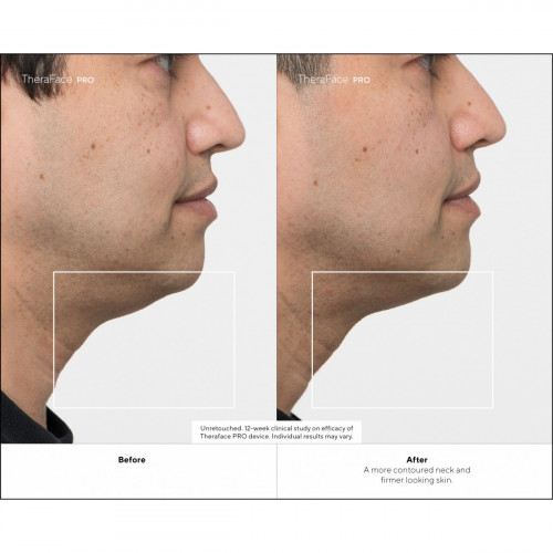 Therabody - TheraFace Pro Nero, la soluzione...