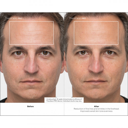 Therabody - TheraFace Pro Nero, la soluzione...