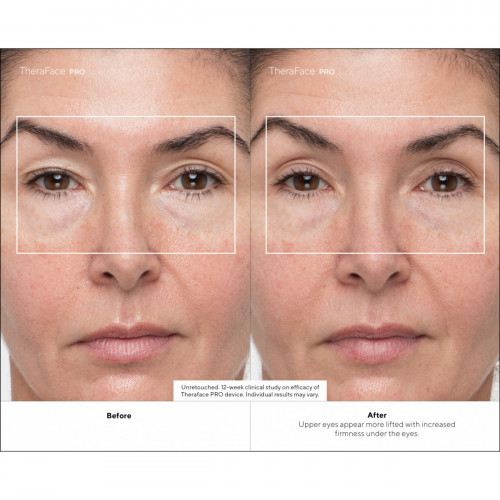 Therabody - TheraFace Pro Nero, la soluzione...